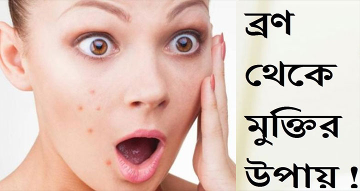 জেনে নিন ব্রণ থেকে মুক্তি পাওয়ার উপায়