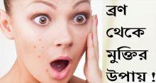 <font style='color:#000000'>জেনে নিন ব্রণ থেকে মুক্তি পাওয়ার উপায়</font>